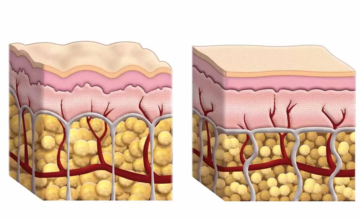 Adipose cells during the use of ceto guru